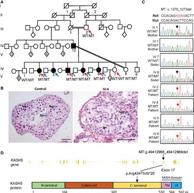 A homozygous KASH5 frameshift mutation causes diminished ovarian reserve, recurrent miscarriage, and non-obstructive azoospermia in humans